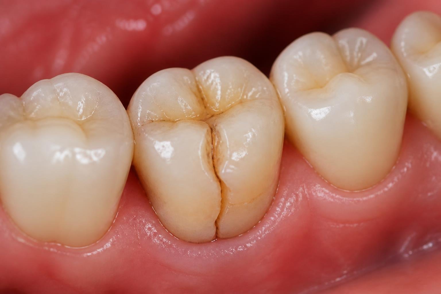 Close-up of a human mouth showing a cracked tooth with the crack extending deeper into the tooth.