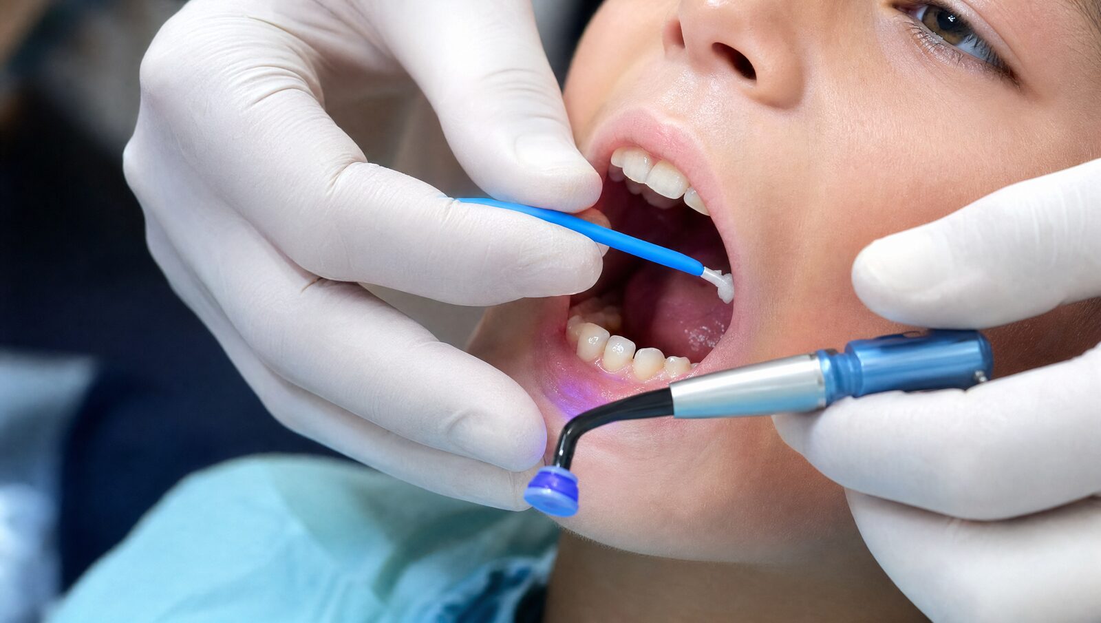 Dentist applying a dental sealant to a child's molar
